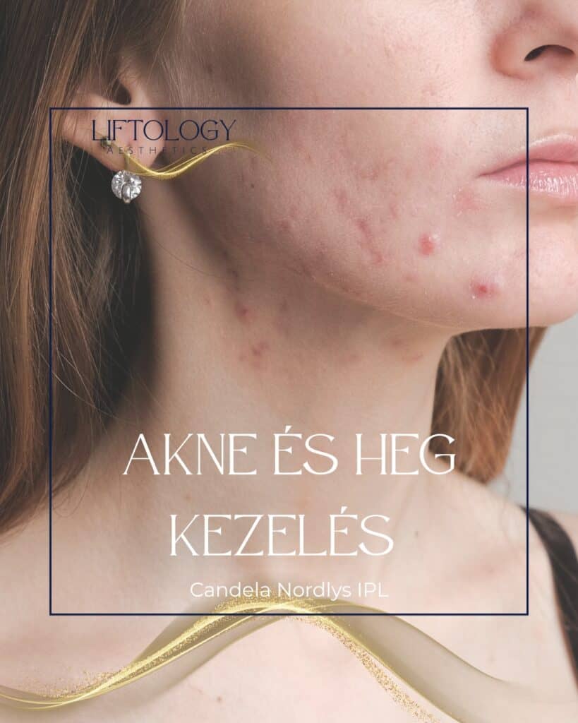 akne-heg-kezeles-candela-nordlys-ipl