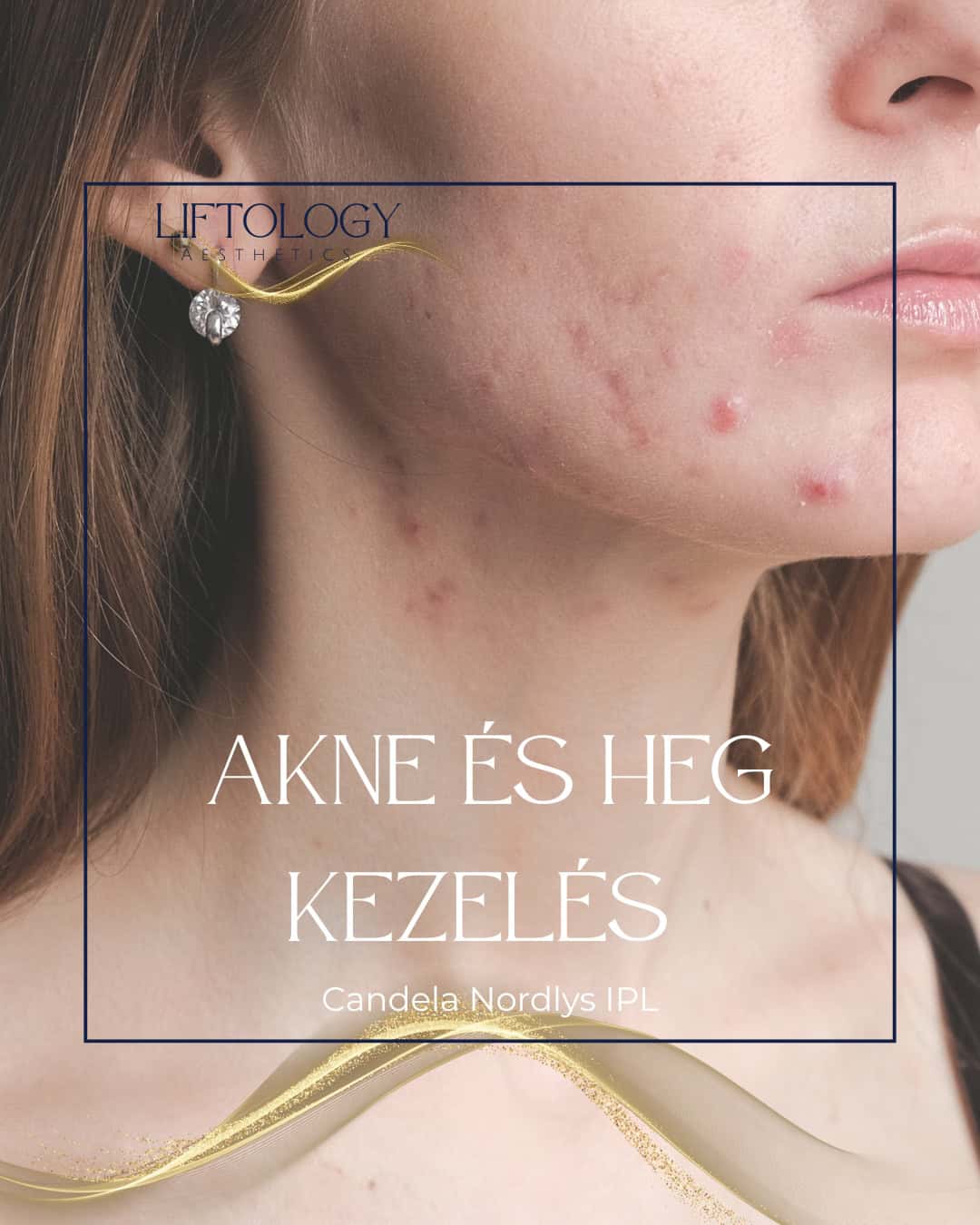 akne-heg-kezeles-candela-nordlys-ipl