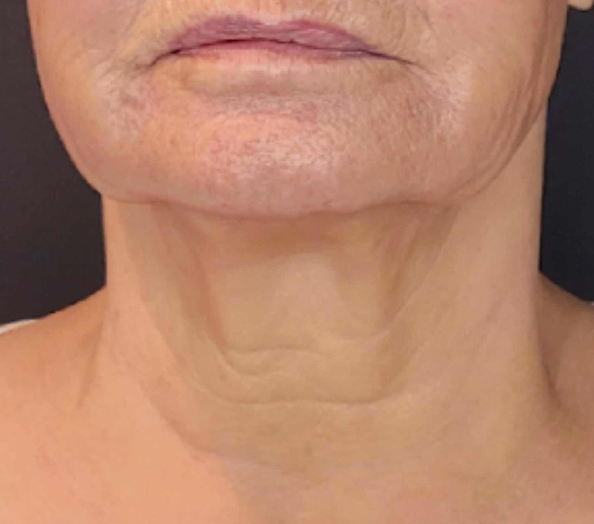 after-3-months-sofwave-neck-procedure-1-at-smile-and-skin-aesthetics-2048x1808