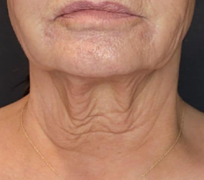 before-sofwave-neck-procedure-1-at-smile-and-skin-aesthetics